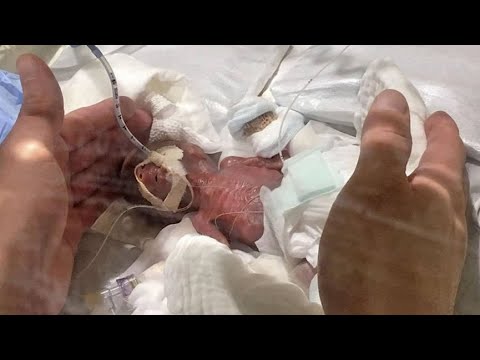 A Baby Boy Who Weighed Less Than 10 Ounces Just Got to Go Home from the Hospital . . . Making Him the Smallest to Ever Survive