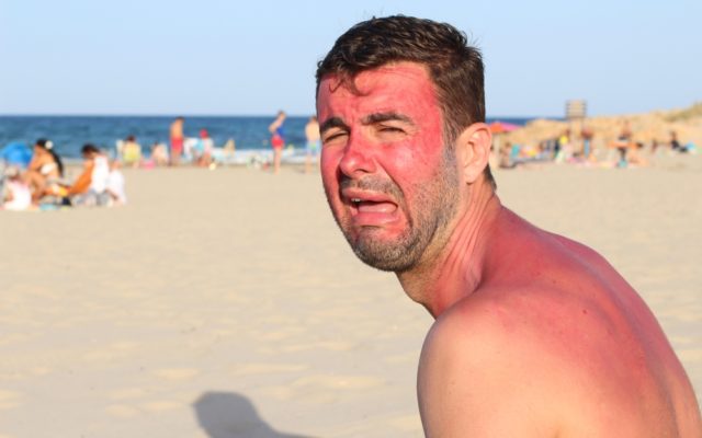 Right Now Is the Worst Time of Year for Sunburns